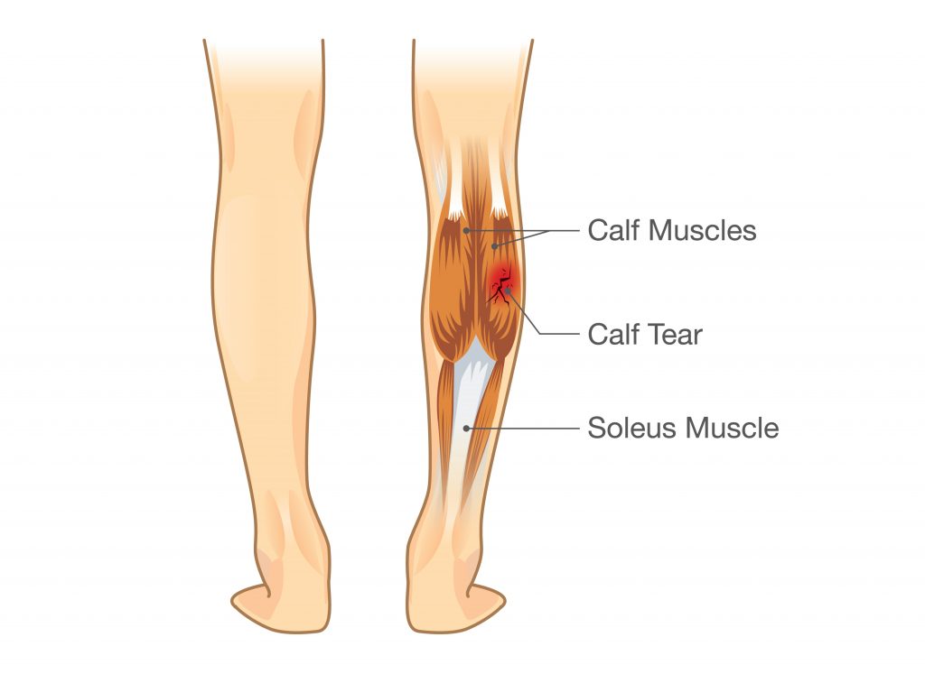 Common Lower Leg and Calf Injuries - My Family Physio