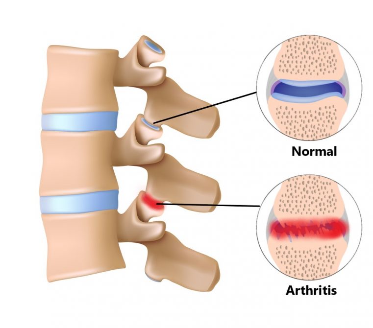 Common Upper Back and Chest Injuries - My Family Physio