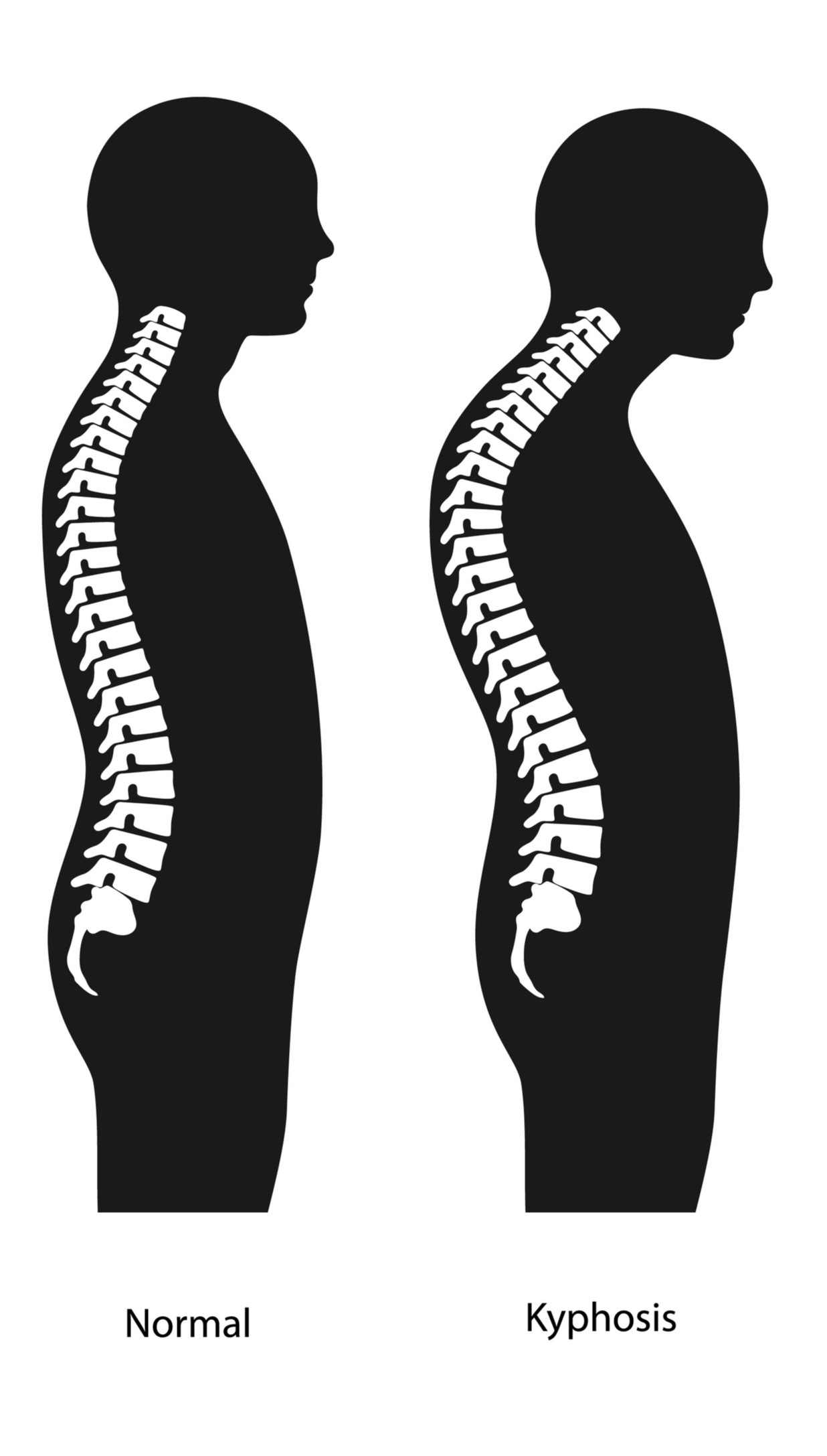 Лордоз это. Flat back осанка. Выпрямление грудного кифоза. Flat back позвоночник. Кифоз выпрямлен грудного отдела.