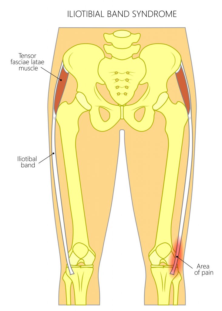 Common Thigh Injuries My Family Physio