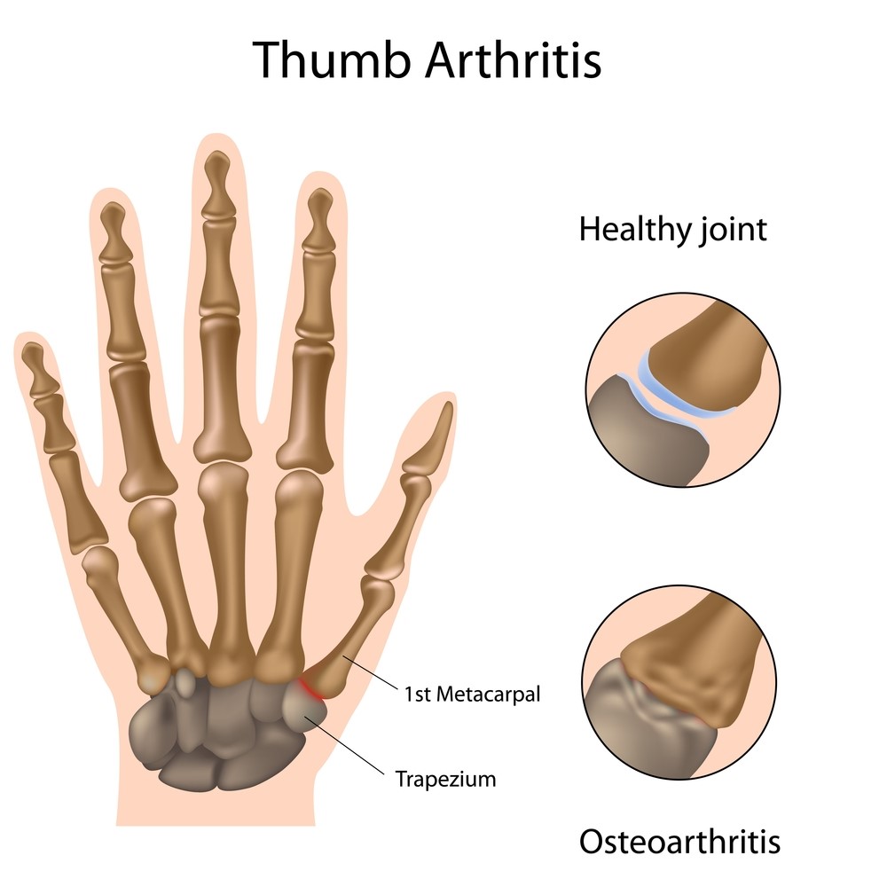 Common Thumb Injuries My Family Physio