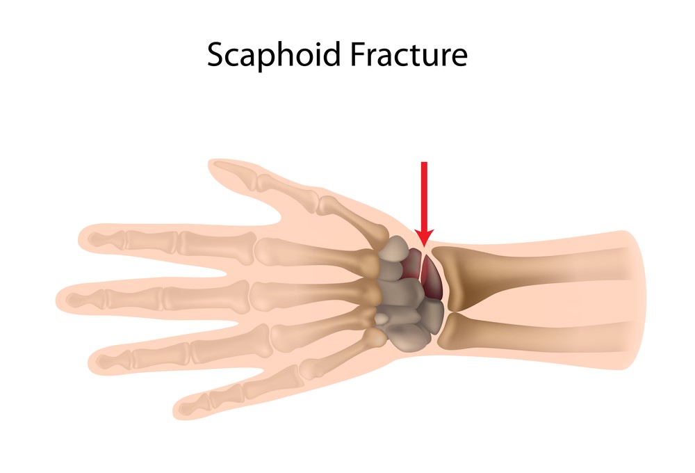 common-thumb-injuries-my-family-physio