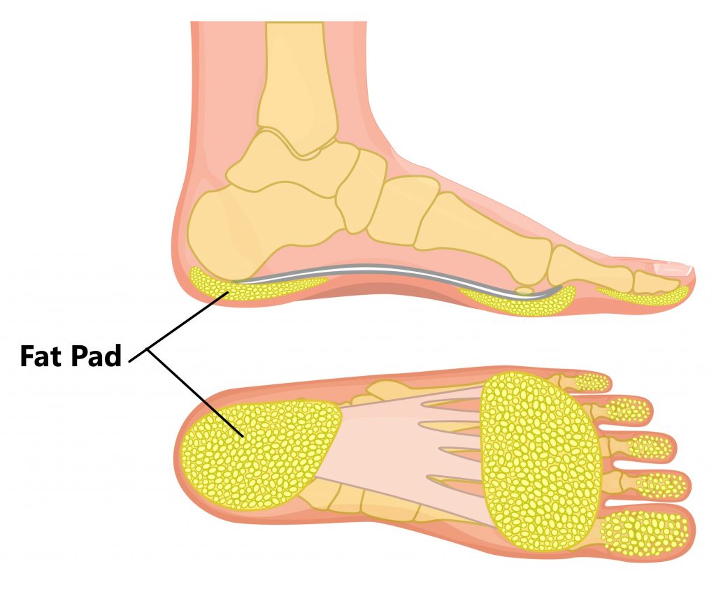 heel cups for fat pad syndrome