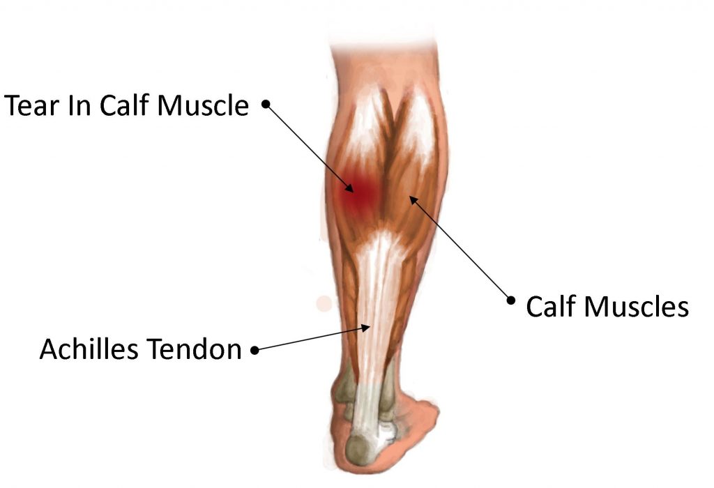 Common Lower Leg and Calf Injuries My Family Physio