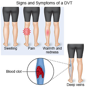 leg calf lower thrombosis vein deep dvt symptoms common injuries signs pain emergency nerve