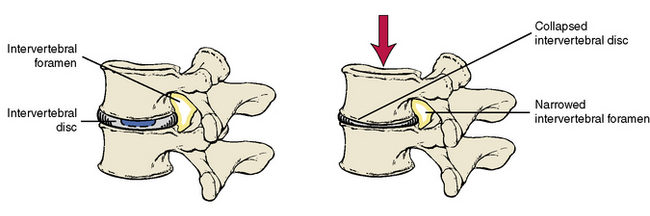 Intervertebral Disc Injuries My Family Physio