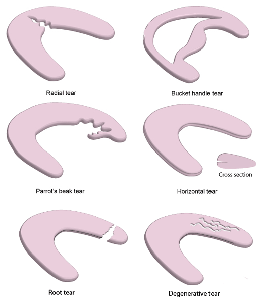 Meniscus Injuries - My Family Physio