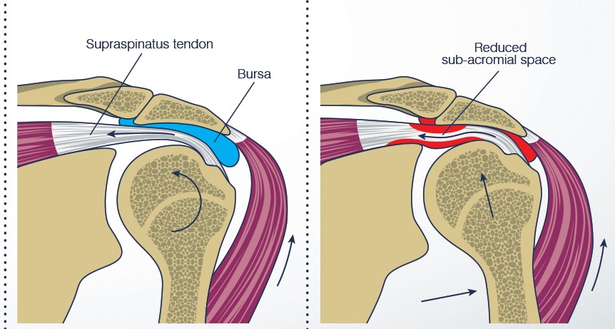 Shoulder Impingement - My Family Physio