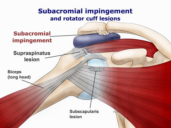 Shoulder Impingement - My Family Physio