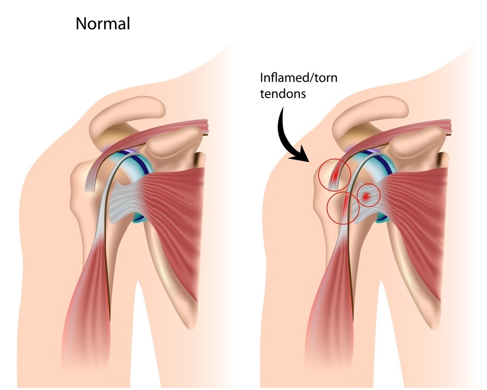 Rotator Cuff Injuries - My Family Physio