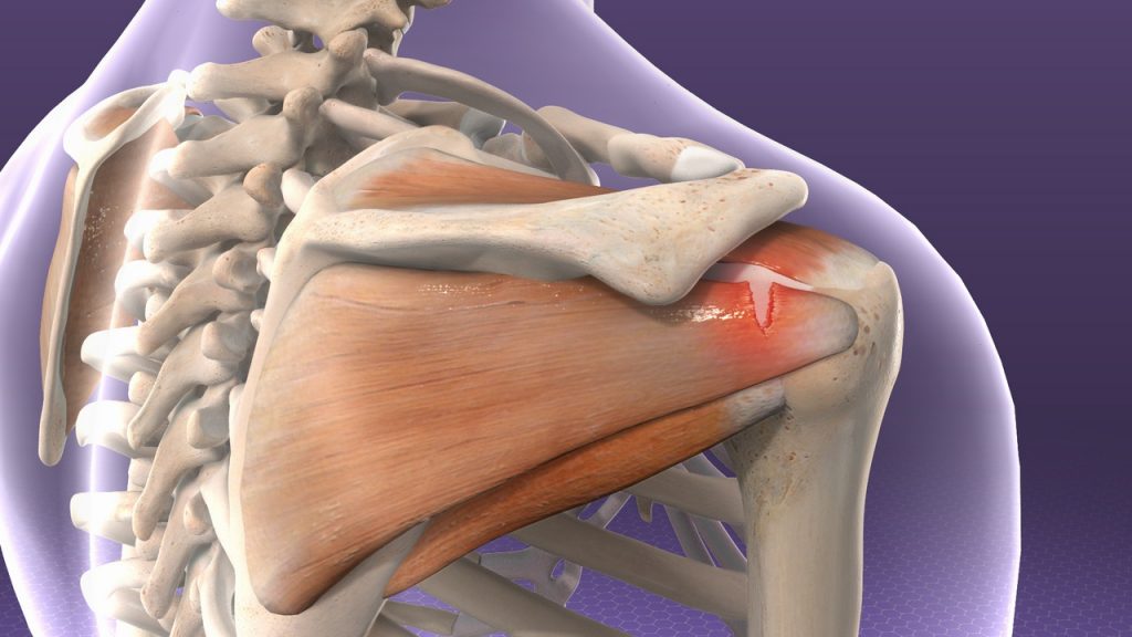 Rotator Cuff Injuries My Family Physio