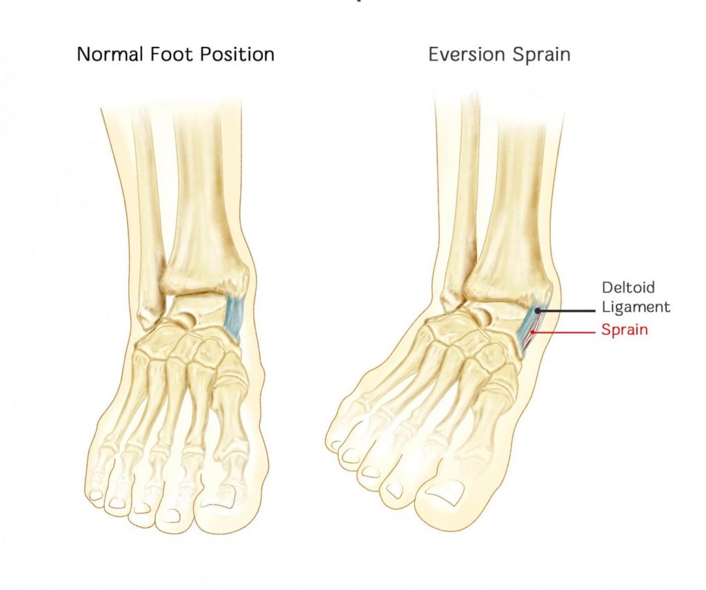 Ankle Sprains - My Family Physio