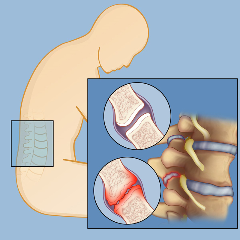 What Is Facet Back Pain