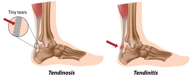 Achilles Tendon Injuries - My Family Physio