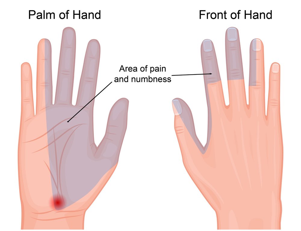 carpal-tunnel-syndrome-cts-cause-pathophysiology-and-treatments