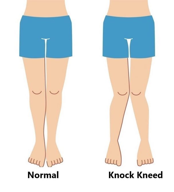 Medial Collateral Ligament (MCL) Injuries - My Family Physio