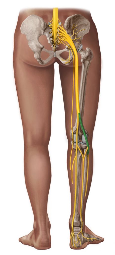 sciatica-my-family-physio