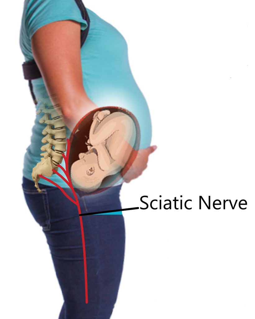 Is Sciatic Pain Constant Or Intermittent