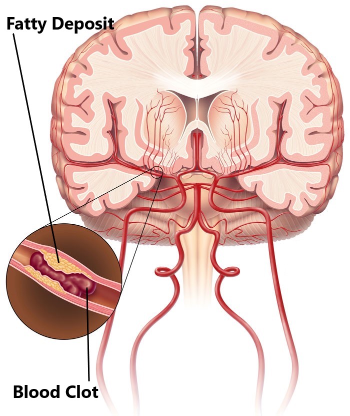 Stroke - My Family Physio