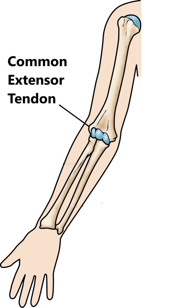 Tennis Elbow (Lateral Epicondylitis) - My Family Physio