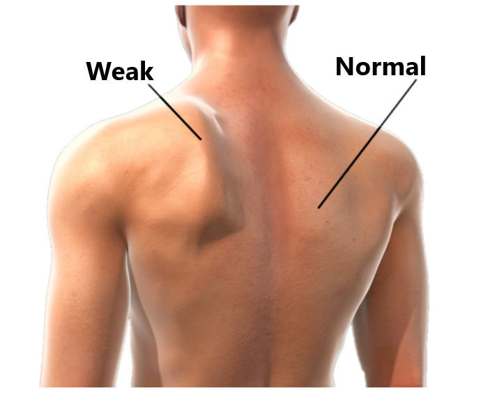 scapula-stability-my-family-physio