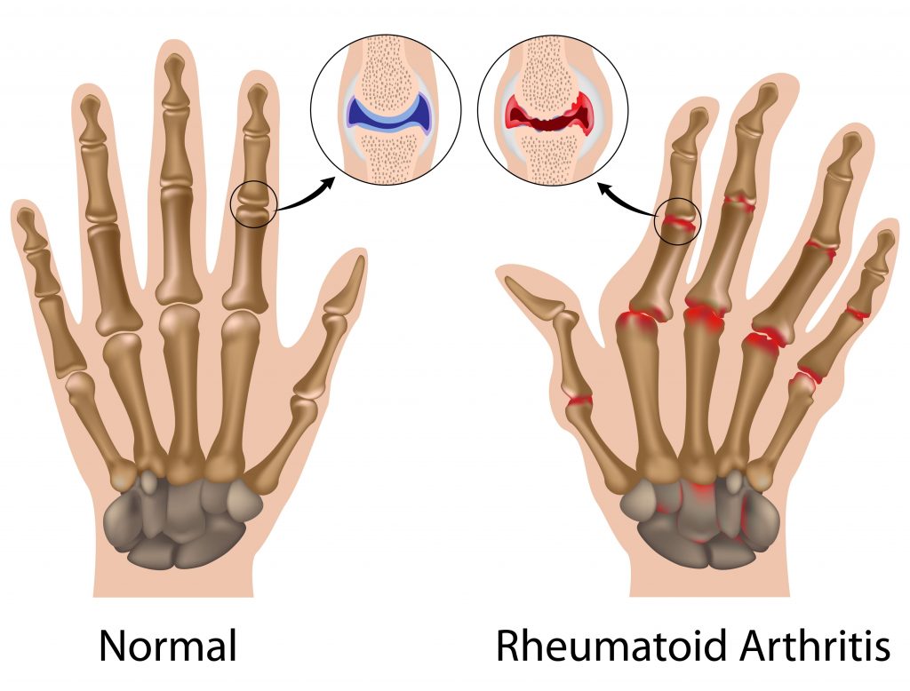 Carpal Tunnel Syndrome - AVALA