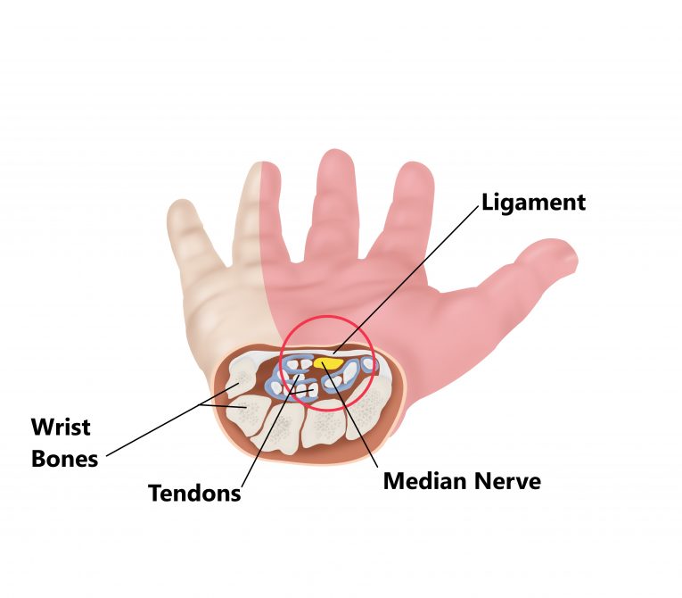 Carpal Tunnel Syndrome - My Family Physio