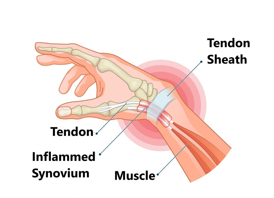Common Thumb Injuries My Family Physio