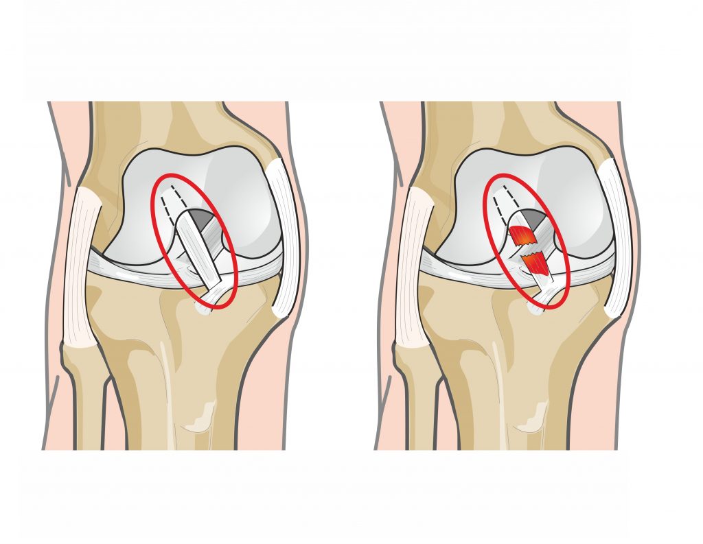 Medial Collateral Ligament MCL Injury Sydney, NSW