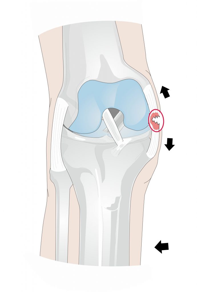 Medial Collateral Ligament (MCL)