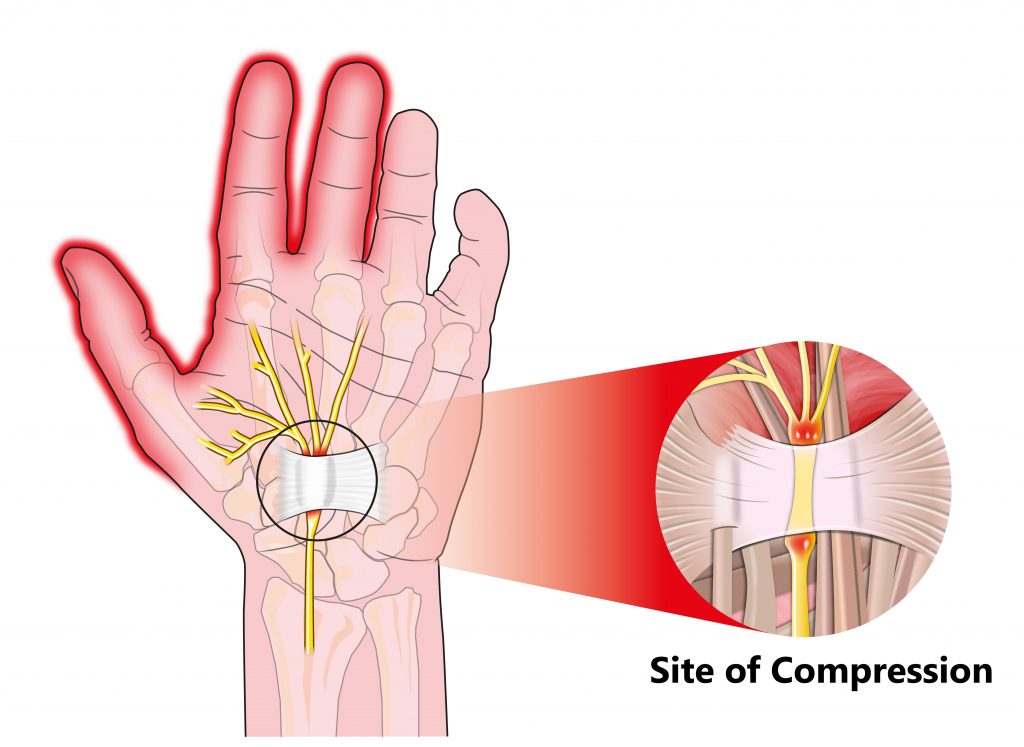 Carpal Tunnel Syndrome - My Family Physio