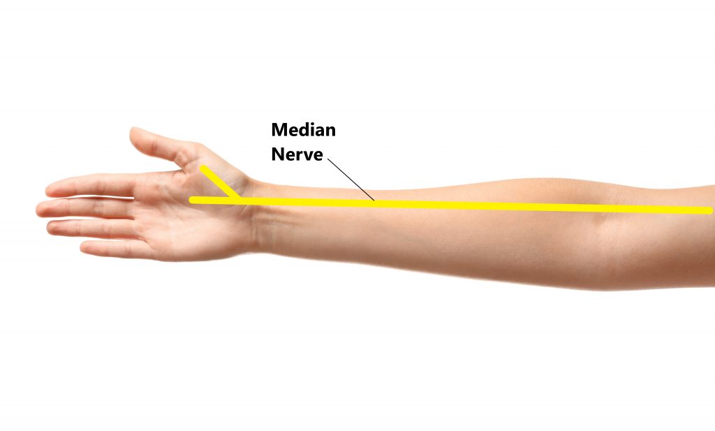 Is your wrist pain carpal tunnel syndrome?