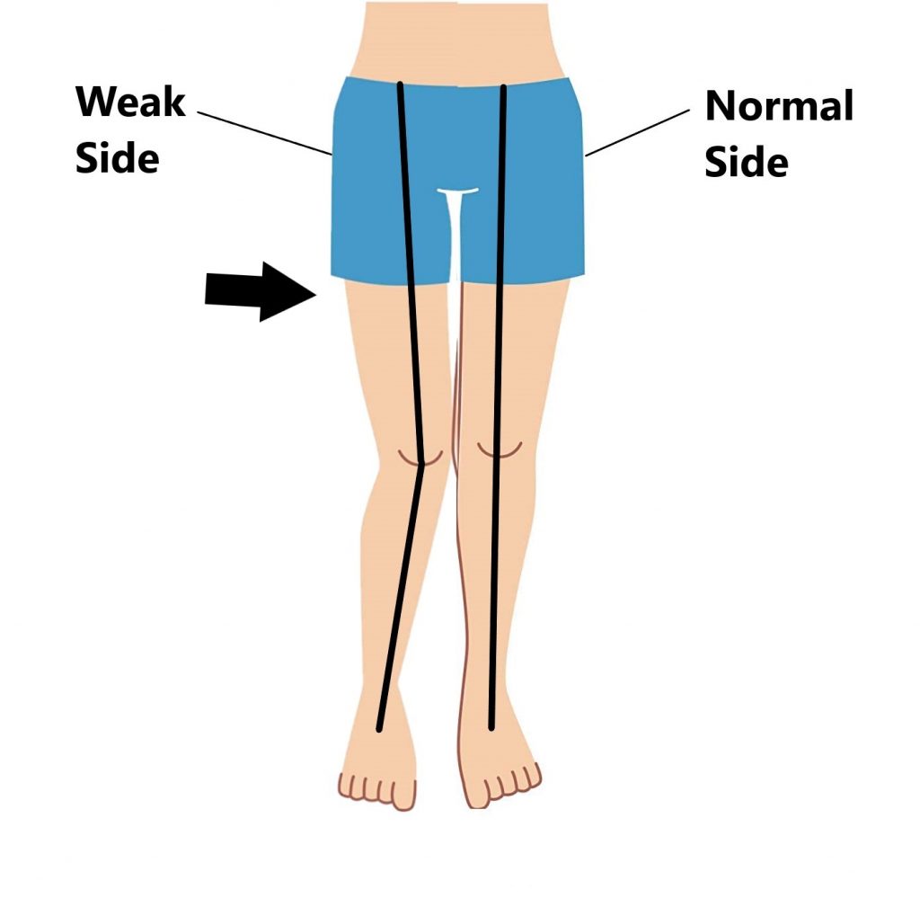 Greater Trochanteric Pain Syndrome (GTPS) - My Family Physio