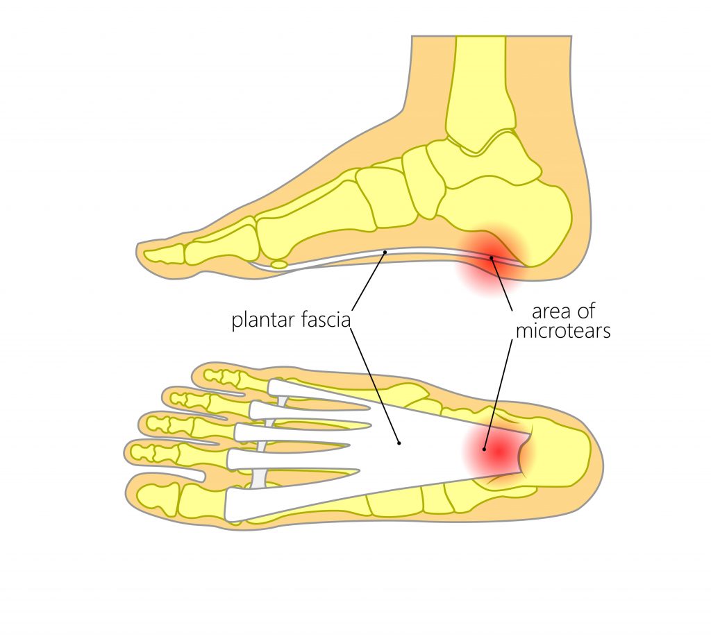 Plantar Fasciitis Pain Management - Propel Physiotherapy