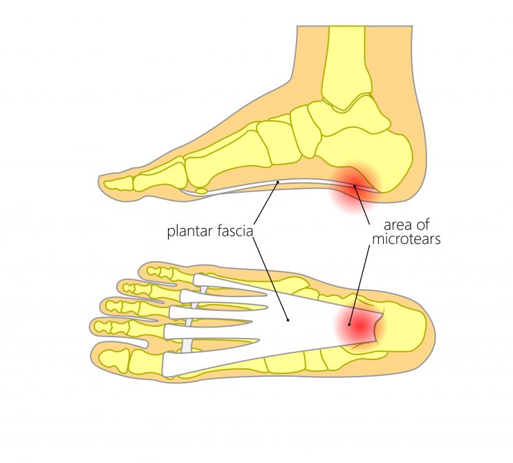 plantar-fasciitis-my-family-physio