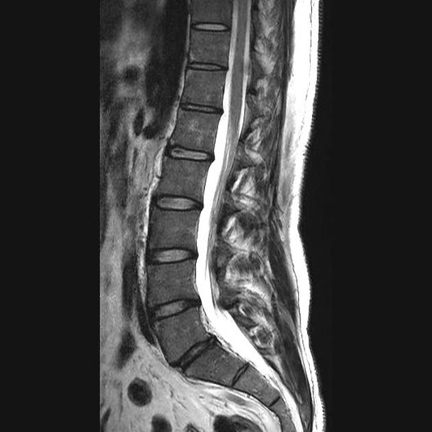 Ankylosing Spondylitis Mri Lumbar Spine