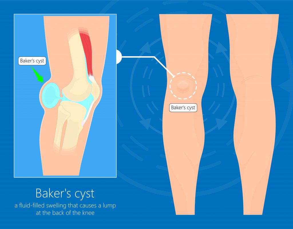 pain in front of knee cap