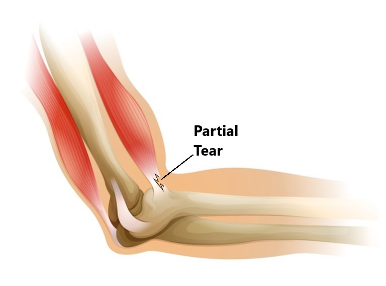 Biceps Tendon Injuries My Family Physio