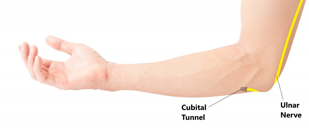 Cubital Tunnel Syndrome - My Family Physio