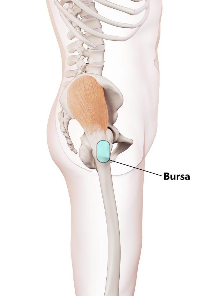 What is Greater Trochanteric Pain Syndrome (GTPS)?