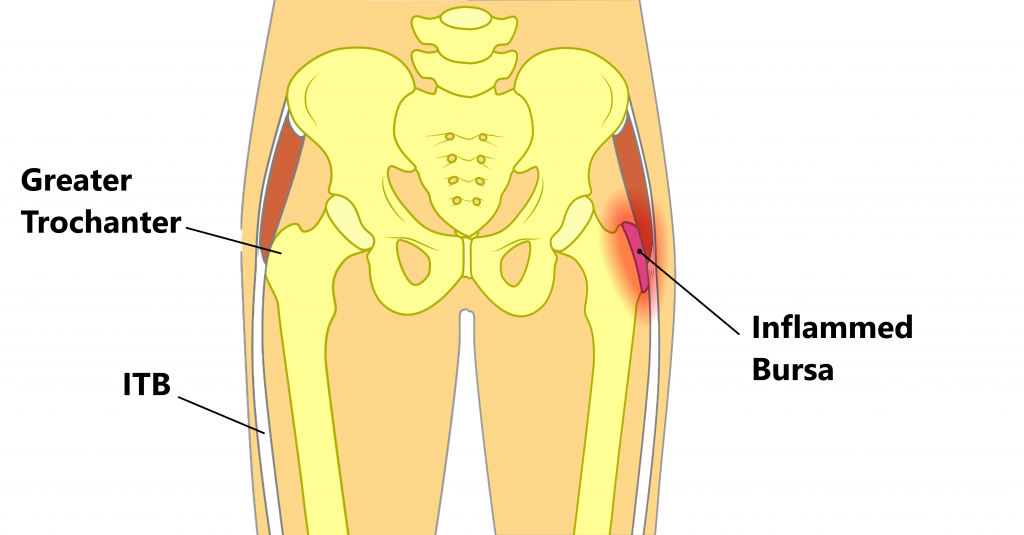 Greater Trochanteric Pain Syndrome Guide - Ethos Health