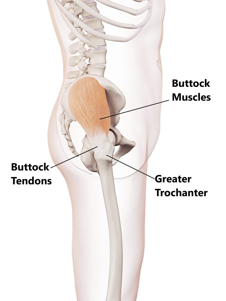 Greater Trochanteric Pain Syndrome Guide - Ethos Health