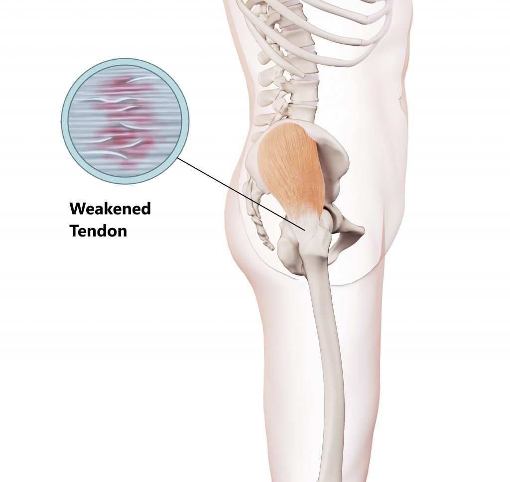 Anatomy Stock Images  hip-greater-trochanteric-pain-syndrome