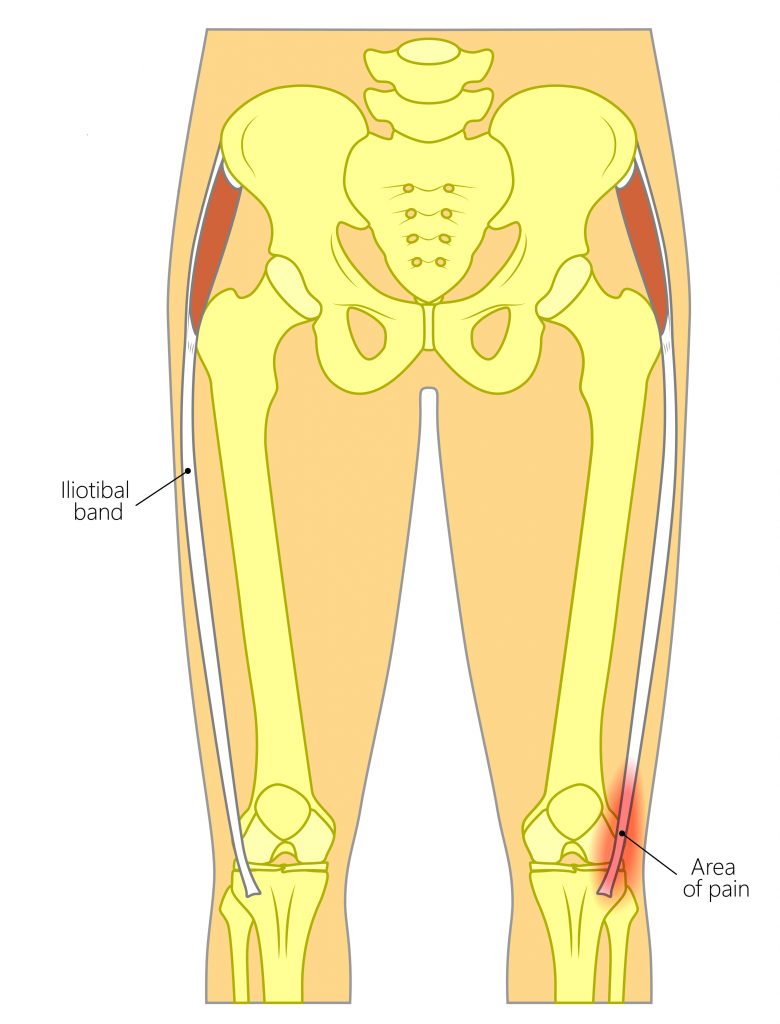 IONA Physiotherapy - WHAT AND WHERE IS THE ILIOTIBIAL BAND (ITB)?? Also  known as the ITB, the iliotibial band runs along the outside of the  thigh. It is thick band of fascia