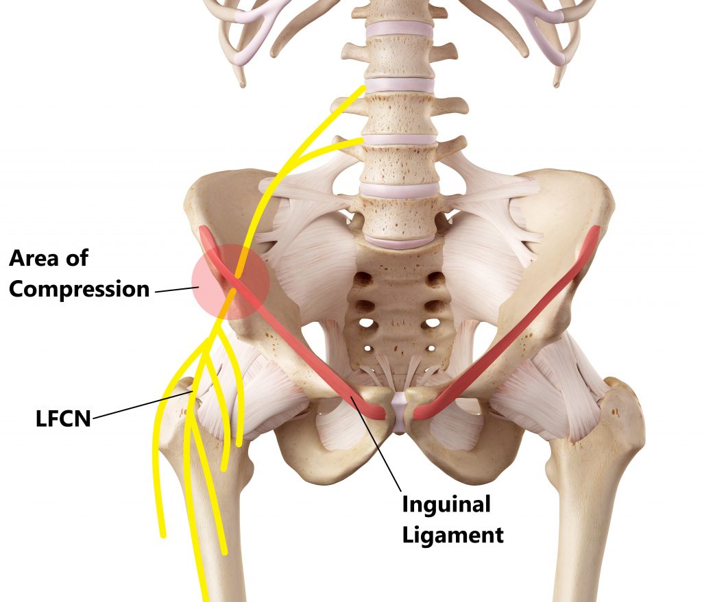 LFCN Entrapment (Meralgia Paresthetica) - My Family Physio