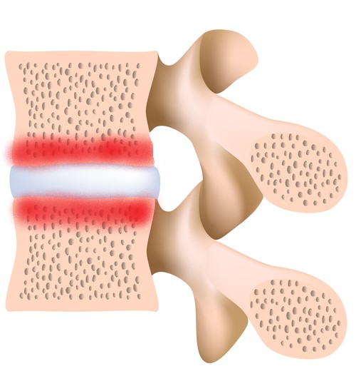 Modic Changes My Family Physio