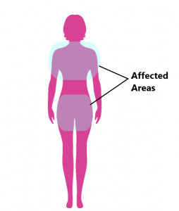 Polymyalgia Rheumatica - My Family Physio