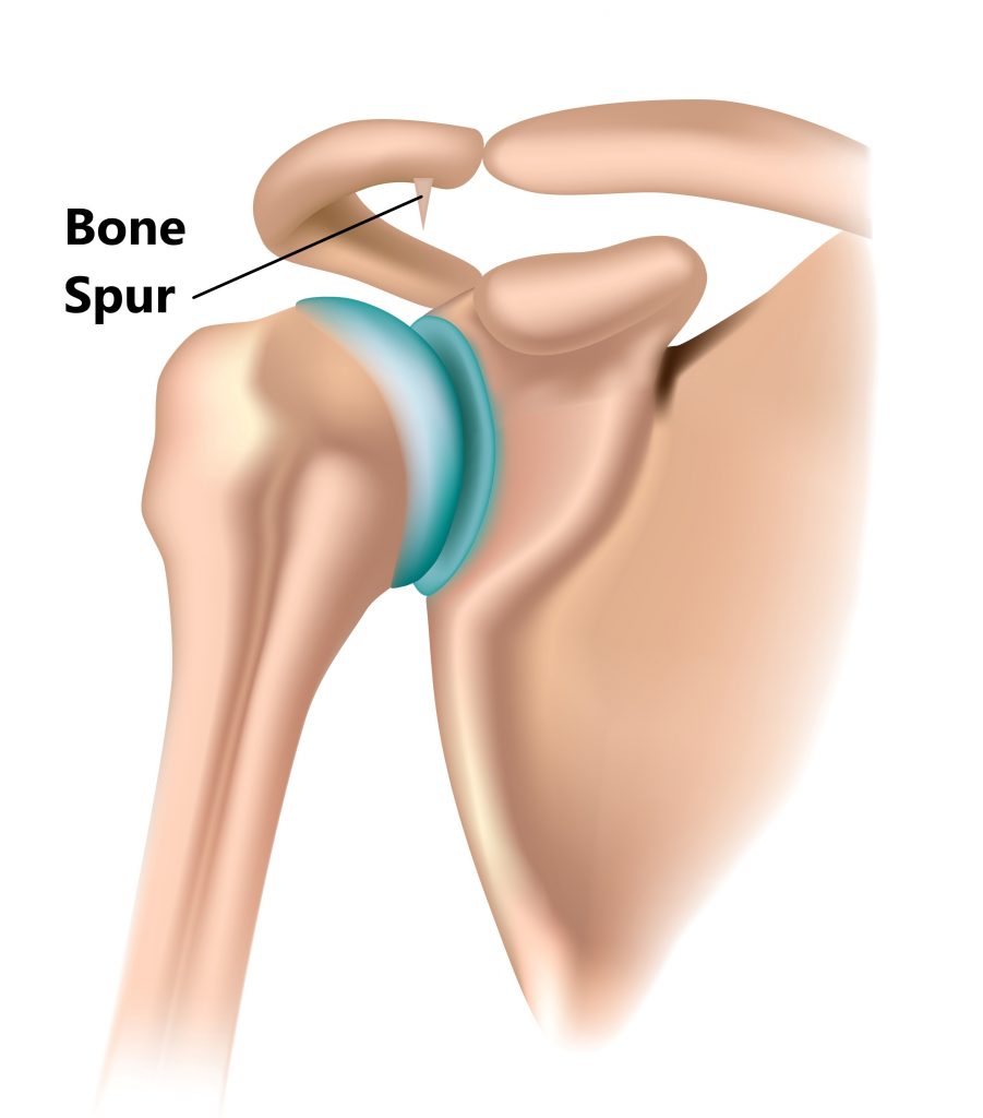 shoulder-impingement-my-family-physio