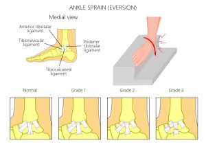 Ankle Sprains - My Family Physio