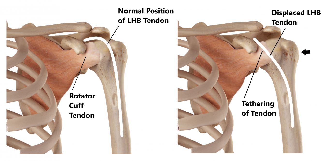 Biceps Tendon Injuries - My Family Physio